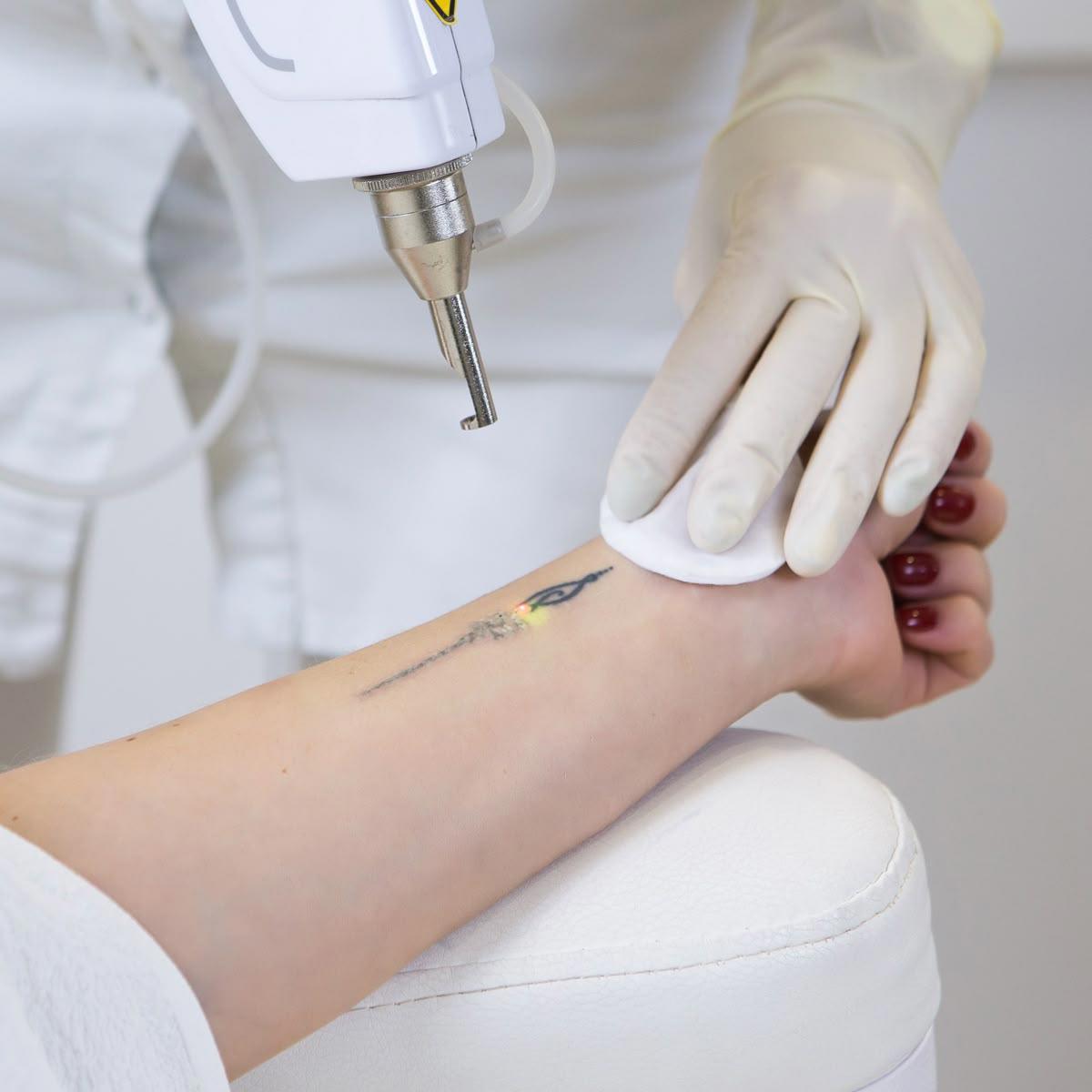 Laser Tattoo Removal in Cambridge: What You Need to Know