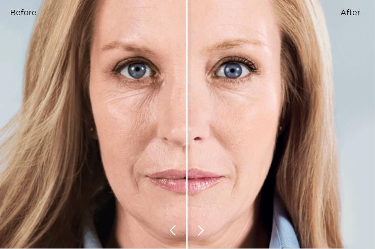 Sculptra® / PLLA Treatment in Cambridge: The Collagen-Stimulating Treatment for Natural Facial Rejuvenation